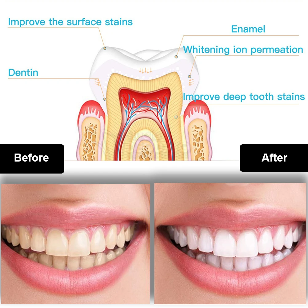 Dental Teeth Whitening Kit Min - Teeth Whitening Gel Pen 评论和价格